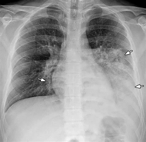 Pneumonia Detection Model